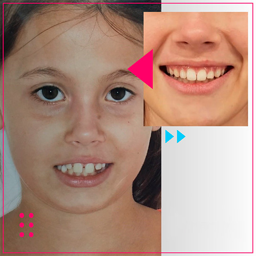 Acompanhamento de Crescimento com Tratamento Ortodôntico