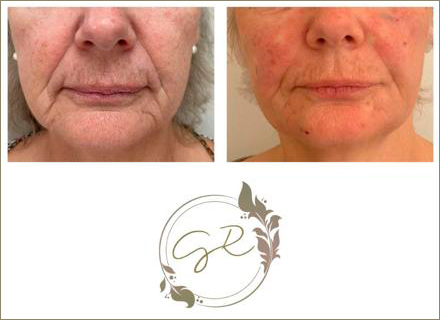 Gabriela Rinaldi - Preenchimento Facial