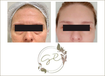 Gabriela Rinaldi - Botox